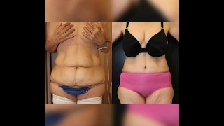 Before and After:  Abdominoplasty // Dr. Gabriel Chiu