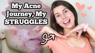I finally got rid of my acne... my story.