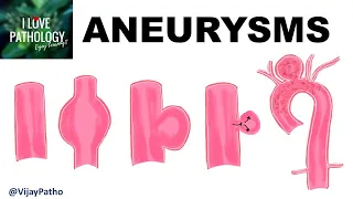 ANEURYSMS- Types , Pathogenesis & Abdominal aortic aneurysm