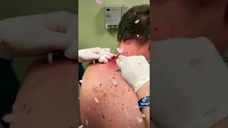 Las Vegas Dermatology Cyst Follow up video 🎥 with incision and drainage procedure 💉 🔪