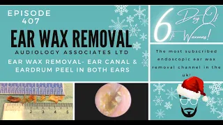 EAR WAX REMOVAL - EAR CANAL & EARDRUM PEEL IN BOTH EARS - EP407