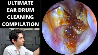 The ULTIMATE EAR DRUM Cleaning Compilation