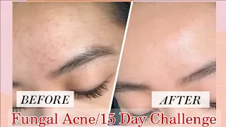 Remove Fungal Acne in 15 Days✨️ | #fyp #glowingskin