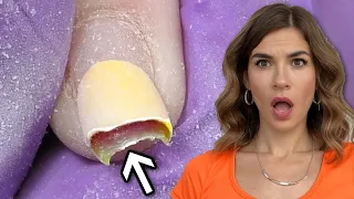 Bitten Nails Transformation with Poly Gel | Thick Product Removal