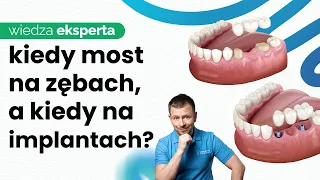 MOSTY NA IMPLANTACH. KIEDY MOST NA ZĘBACH, A KIEDY NA IMPLANTACH? ZALETY MOSTÓW NA IMPLANTACH.