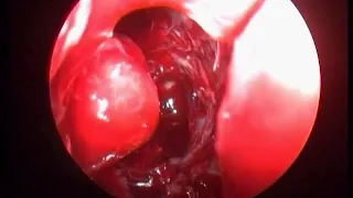 lateral canthotomy for orbital haematoma by dr bharat deshmukh