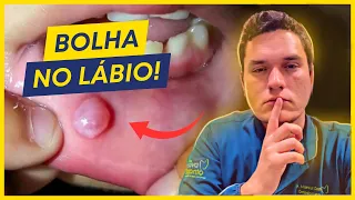 BOLHA NO LÁBIO | MUCOCELE OU RÂNULA? O QUE PODE SER?