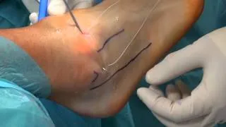 Suture shuttle in chronic ankle instability