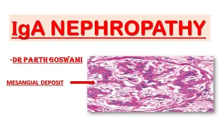 IgA Nephropathy | Simplified Explanation.