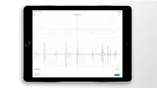 Atrial Fibrillation Combined Heart Sound, PCG & ECG Example - EkoCLINIC App