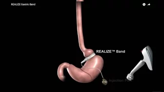 Gastric Banding Bariatric Surgery Animation