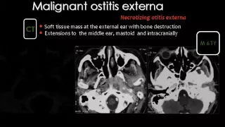 Imaging of Petrous bone II    Prof Dr  Mamdouh Mahfouz In Arabic