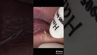 Blackheads extracted from the lips 😌