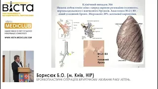 Бронхопластичні операції в хірургічному лікуванні раку легень.