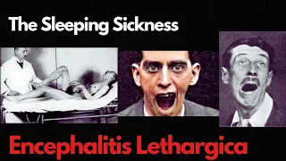 Unraveling the Mystery of Encephalitis Lethargica: The Sleeping Sickness