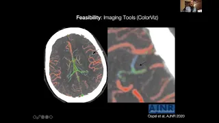 Dr.Mayank Goyal - Medium Vessel Occlusion MeVO Management