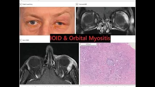 Idiopathic orbital inflammatory disease & Orbital myositis #kanskiseries #2022 #2023