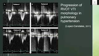 Evaluating RVOT (Right Ventricular Outflow Tract) With Ultrasound and Doppler