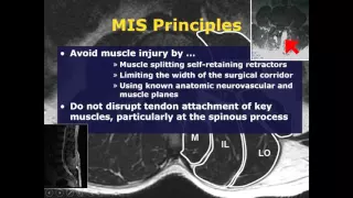 The role of microsurgery and navigation in Minimally invasive Spinal Surgery