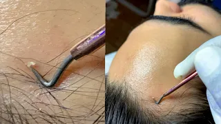 {ASMR} 6x Zoomed Extracting Face whiteheads with new tool ~ soo satisfying