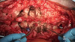 Lab Demo: C7, T1, T2 Pedicle Screws - Charles Sansur, MD, MHSc