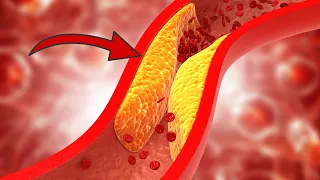 Arteriosklerose rückgängig machen: SO reinigst du deine Arterien ⚡️