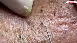 The Best Way to Remove Blackheads from an Elderly