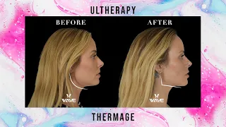 Ultherapy vs Thermage: Non Surgical Facelift with Collagen Stimulation | Wave Plastic Surgery