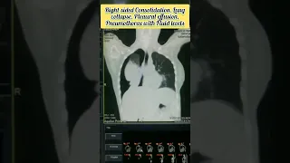 CT Scan Chest 😱🔥😭 Multiple lung Disease Processes #medical #radiology #viral #ctscan #shorts #reels