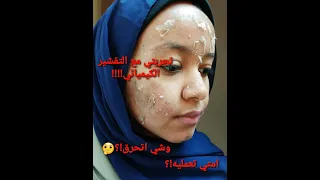 تجربتي مع التقشير الكيميائي!!!!!!