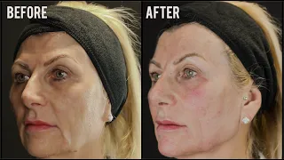 Julie receives Facelift using Dermal Fillers | SkinViva Manchester