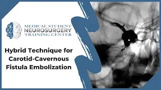 Hybrid Technique for Carotid-Cavernous Fistula Embolization