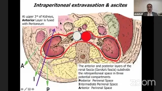 Collecting System Injury in PCNL || PCNL Complication || Urology ||