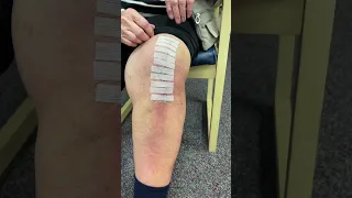 Remove Those Strips After Knee Replacement