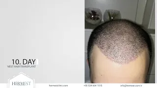 Hair Transplant in Turkey Before After (Month 1-12)  | Hair Transplant Results of Hermest