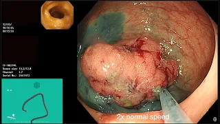 LARGE POLYP ARISING FROM APPENDICULAR ORIFICE