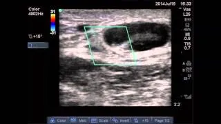 An Abscess is not always an Abscess