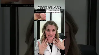 Chemical Peels options (ZO Stimulator Glows vs VI Chemical Peels)