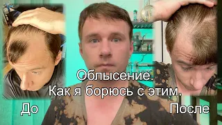 Как побороть облысение? Мой опыт рабочего средства. Фото до и после.