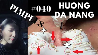 #040 | PICK UP PIMPLES for Hien | Lấy nhân mụn cho em Hien | Hương Đà Nẵng Official