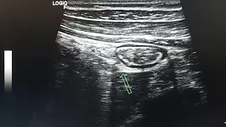 practical tip - how to identify the descending colon by ultrasound