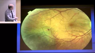 Posterior Uveal Melanoma