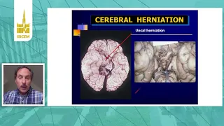 ISICEM, Intracranial Htn, Hypertonic fluids when and how Marek Mirski Baltimore, United States