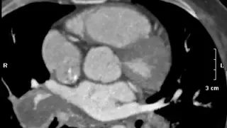 Incedinatal finding during CT coronary angiography ,,, CAD-RADs  0