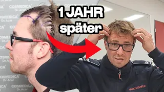 1 Jahr nach meiner Haartransplantation