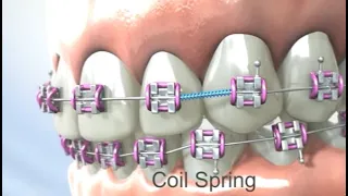 Components of Braces: Understanding Each Part