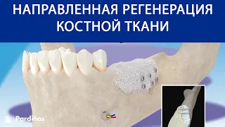 Направленная регенерация костной ткани ©