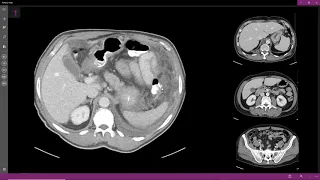 Tuberculose peritoneal