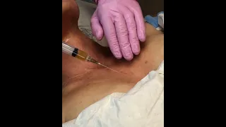 Rejuvapen microneedling with PRP