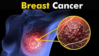 What Happens in Breast Cancer? | Symptoms And Treatment (Urdu/Hindi)